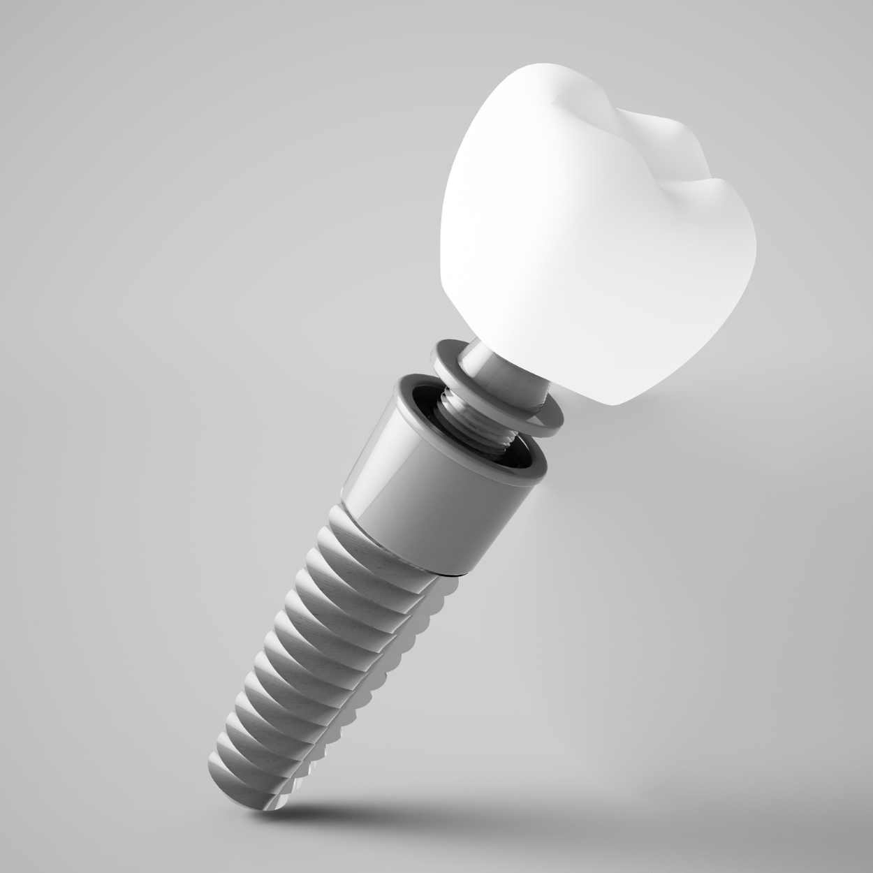 Dental implants with digital planning