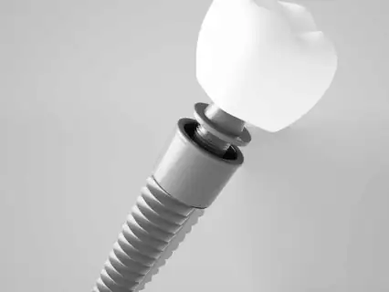 Implantes dentales con planificación digital